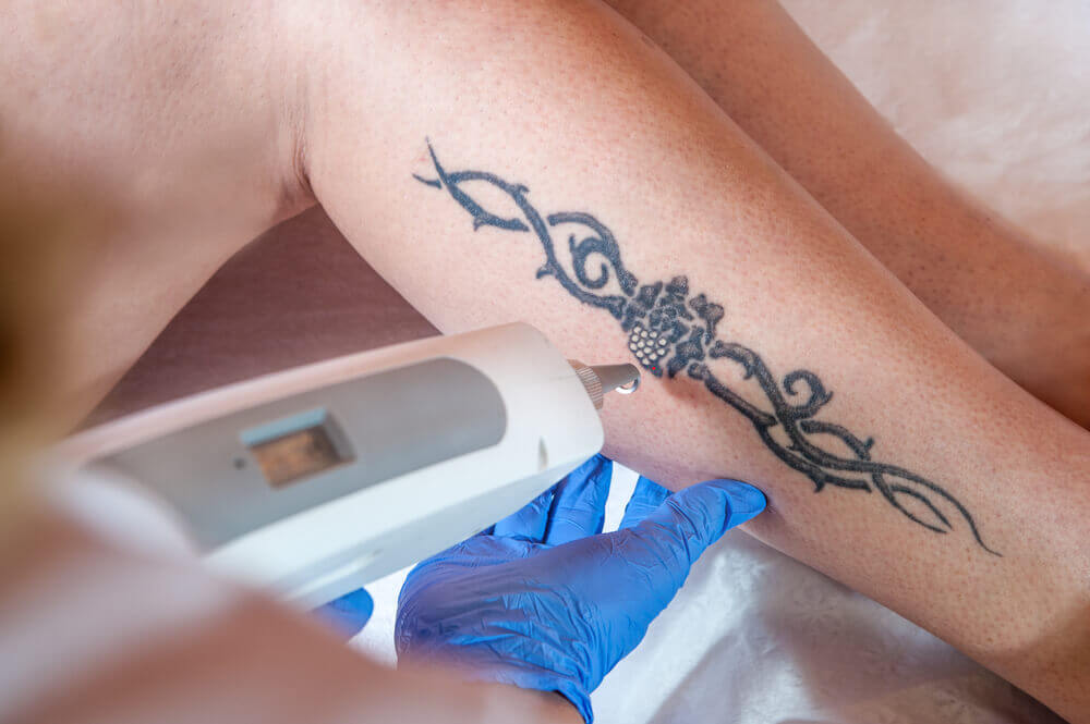 Indepartare tatuaje